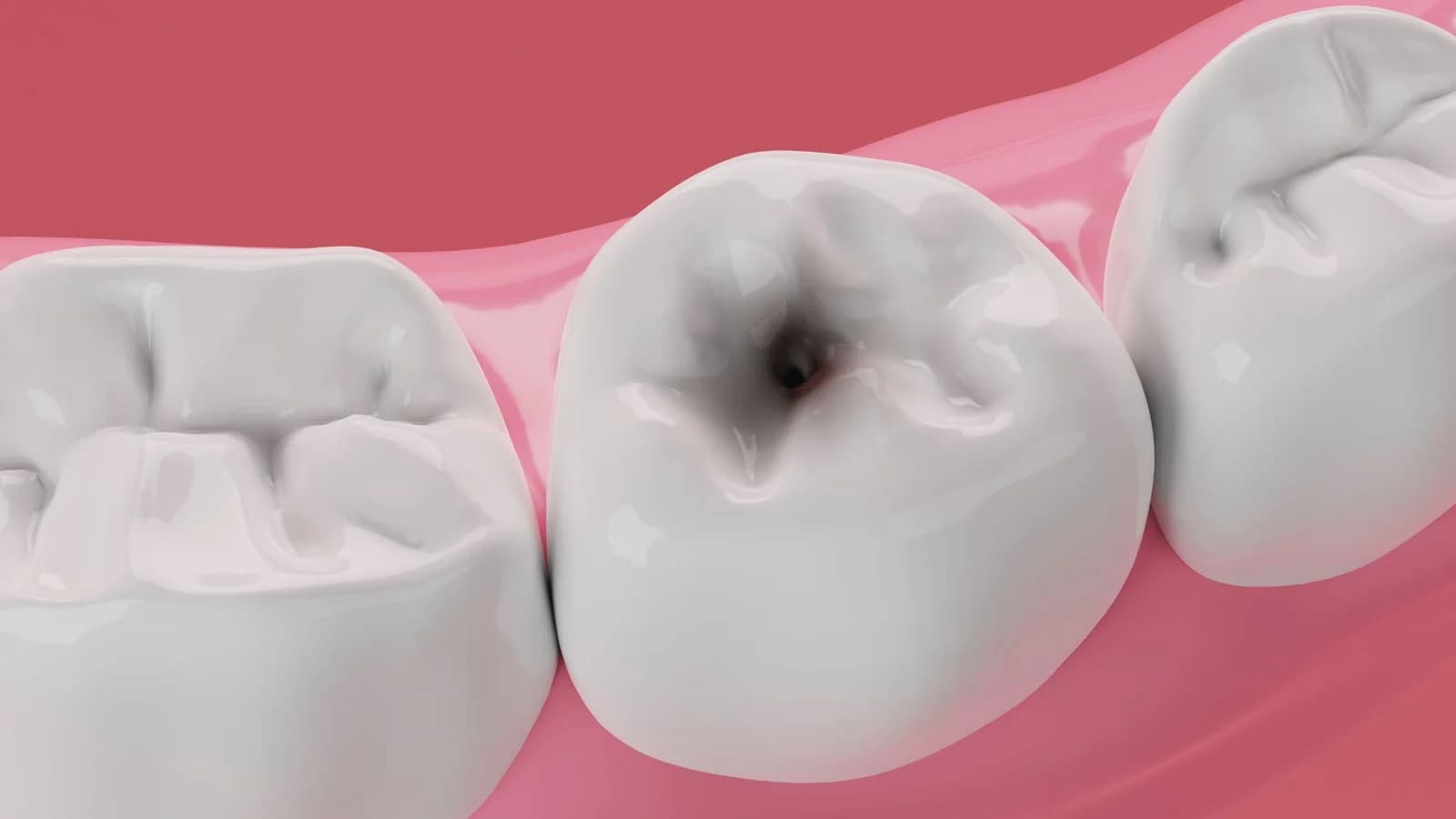 Dentist placing tooth-colored cavity filling at Groot Dental Oshawa