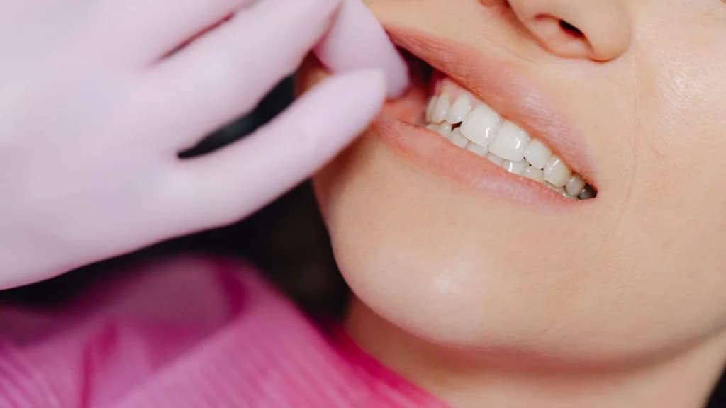 Benefits of dental bonding
