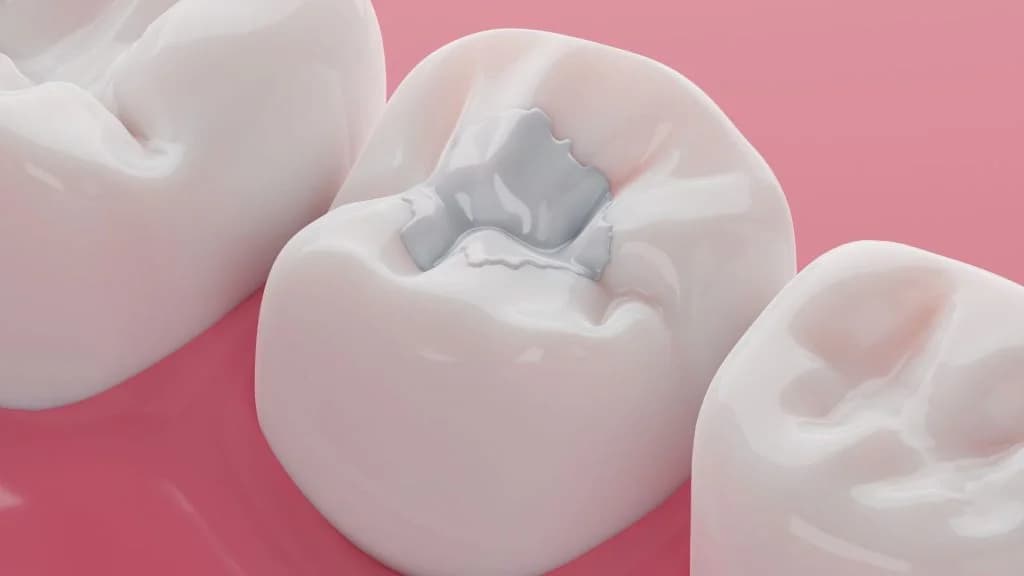 Tooth-colored composite cavity filling restoration at Groot Dental Oshawa