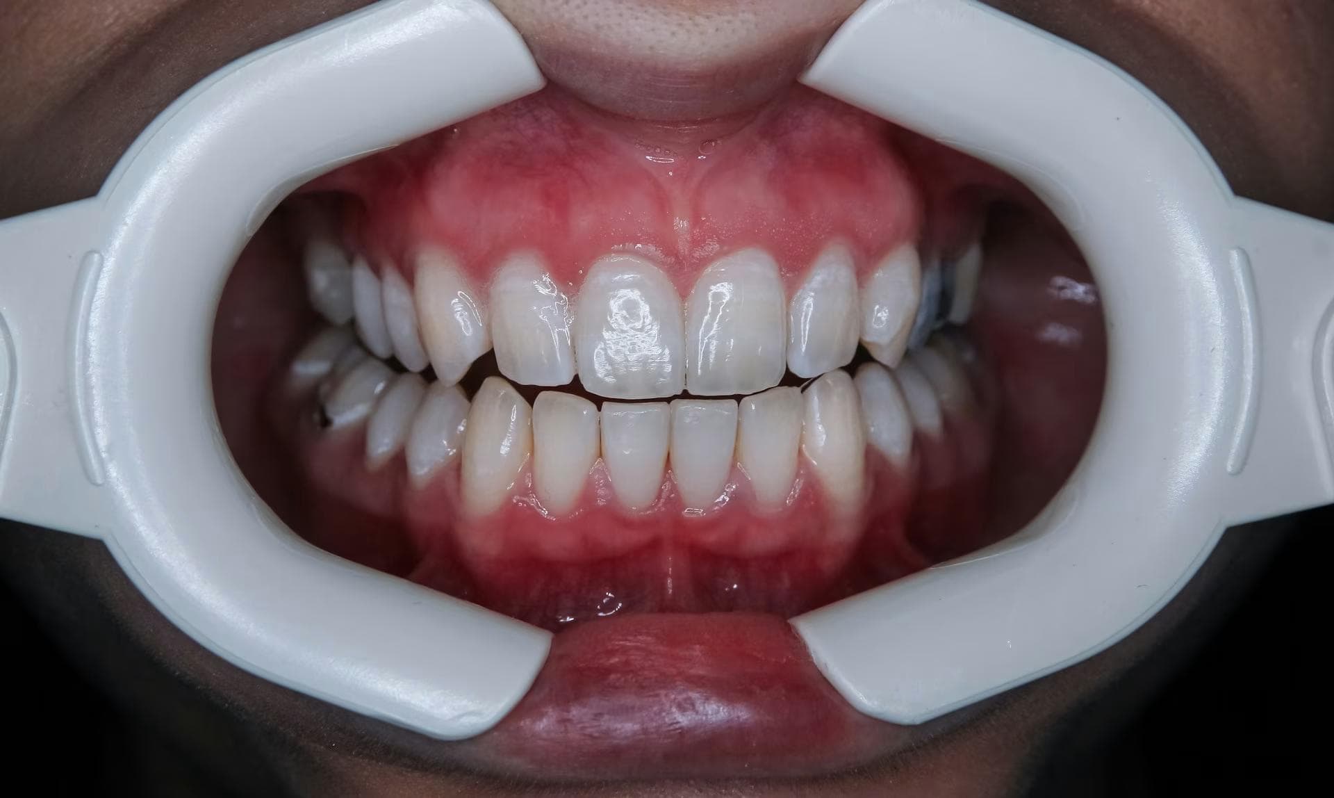 Teeth Whitening in Oshawa: A Dentist's Guide to What Actually Works on Your Stains