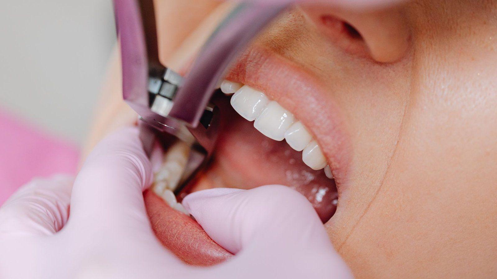 Groot Dental Blog Image