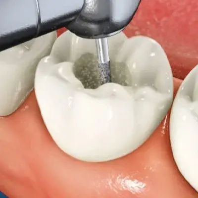 Dental Root Canal: Preserving Your Natural Teeth