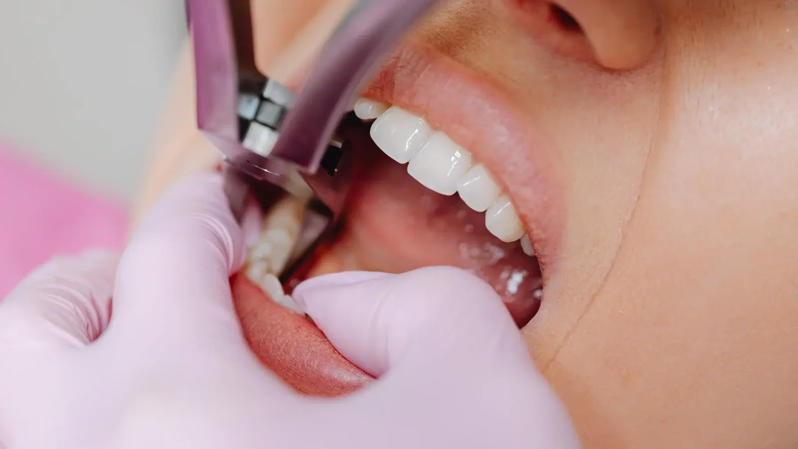 Teeth Extractions in Oshawa - Groot Dental