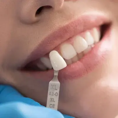 Veneers: Transform Your Smile with Precision