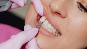 Dental Veneers Treatment