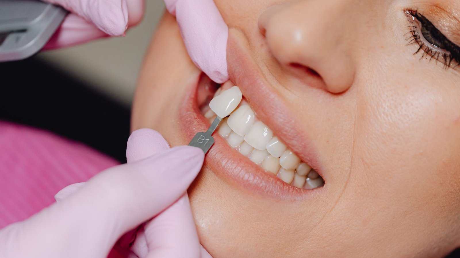 dental veneer’s treatment