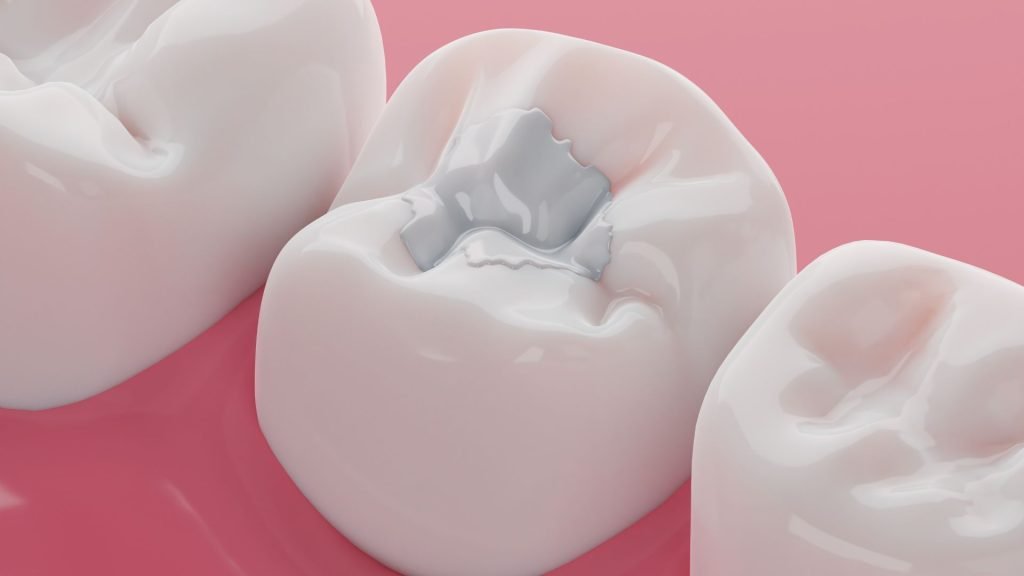 Dental Cavity Filling
