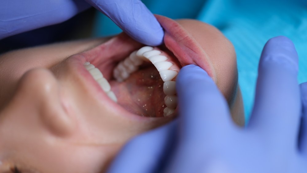 Dental Veneers Treatment